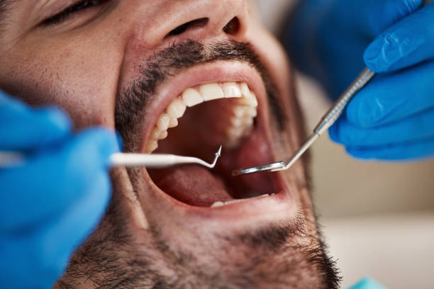 Best Emergency Tooth Extraction in Ricardo, TX